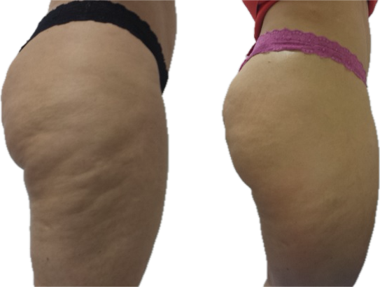 Comparativo de evolução da aparência da celulite — imagem 3