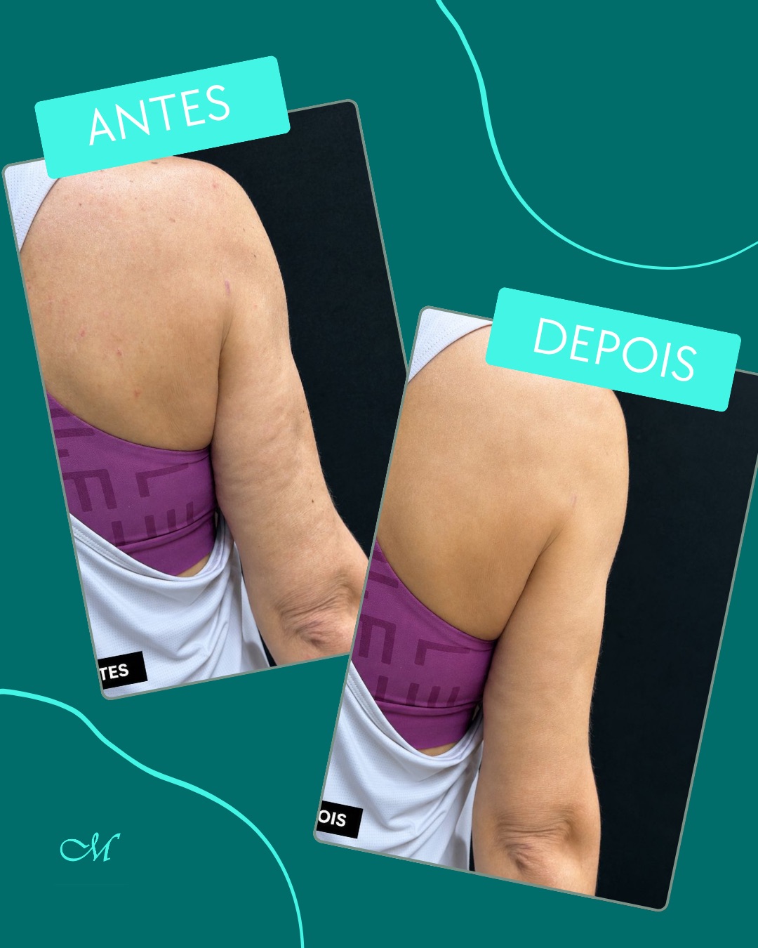 Comparativo de evolução corporal enviado pela clínica — registro 3