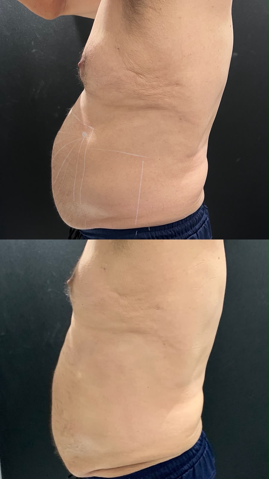 Comparativo de evolução corporal enviado pela clínica — registro 4