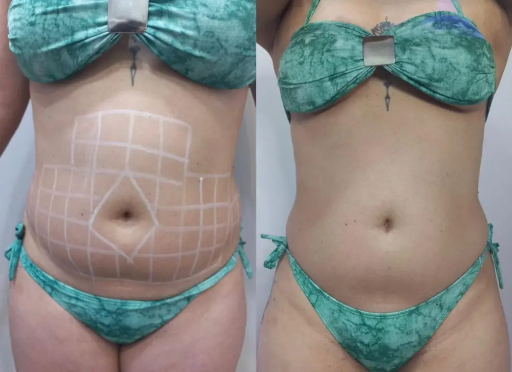 Comparativo de evolução LipoHD — imagem 2