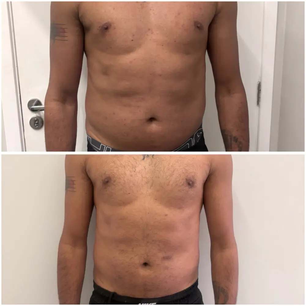 Comparativo de evolução LipoHD — imagem 3
