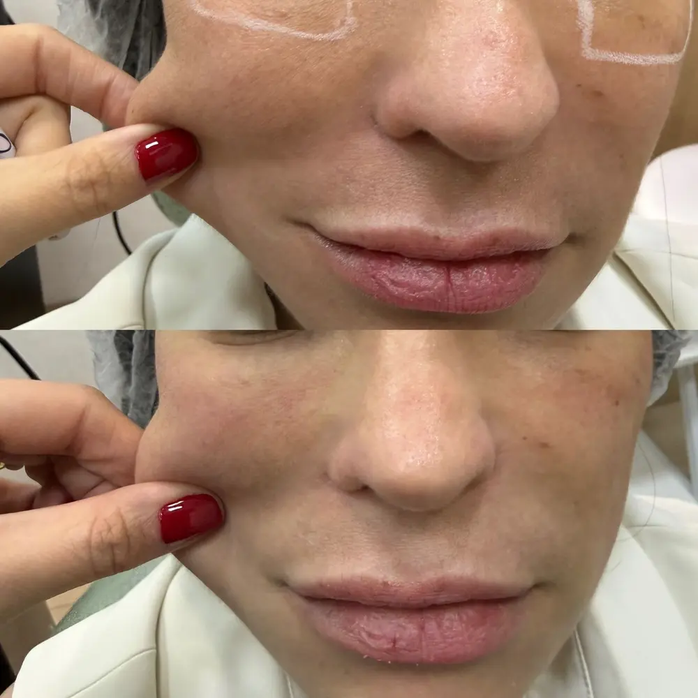 Imagem do Peeling Coreano enviada pela clínica