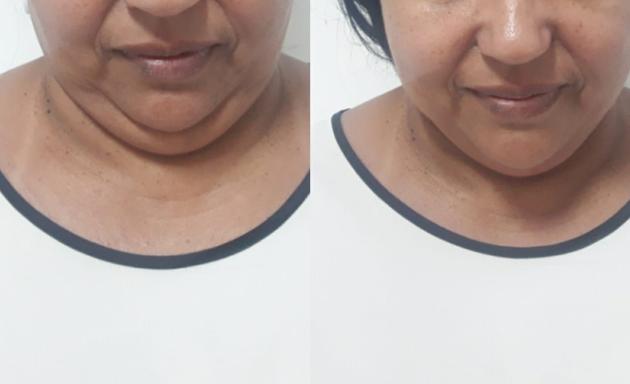 Comparativo de evolução facial ou corporal — registro 1