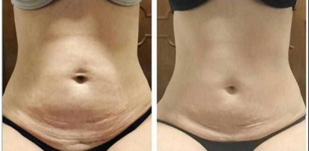 Comparativo de evolução facial ou corporal — registro 2