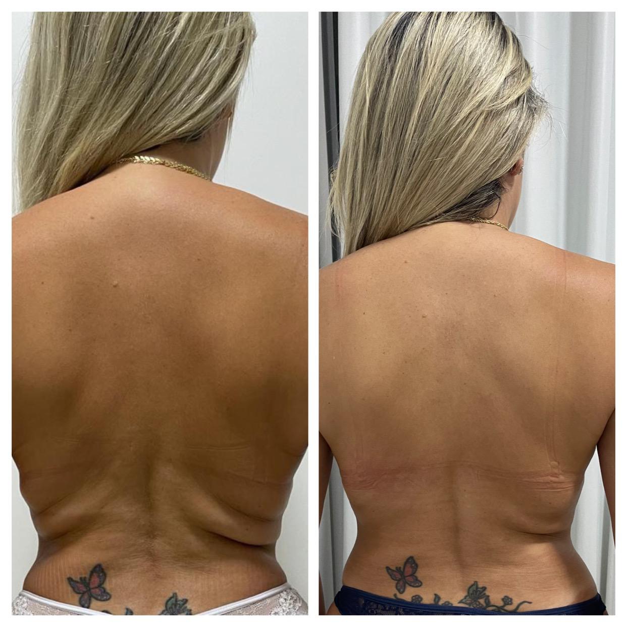 Comparativo de evolução facial ou corporal — registro 3